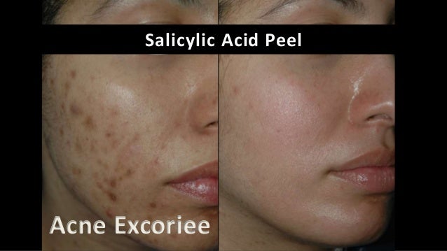 salicylic acid facial peel Swingers clubs in paris